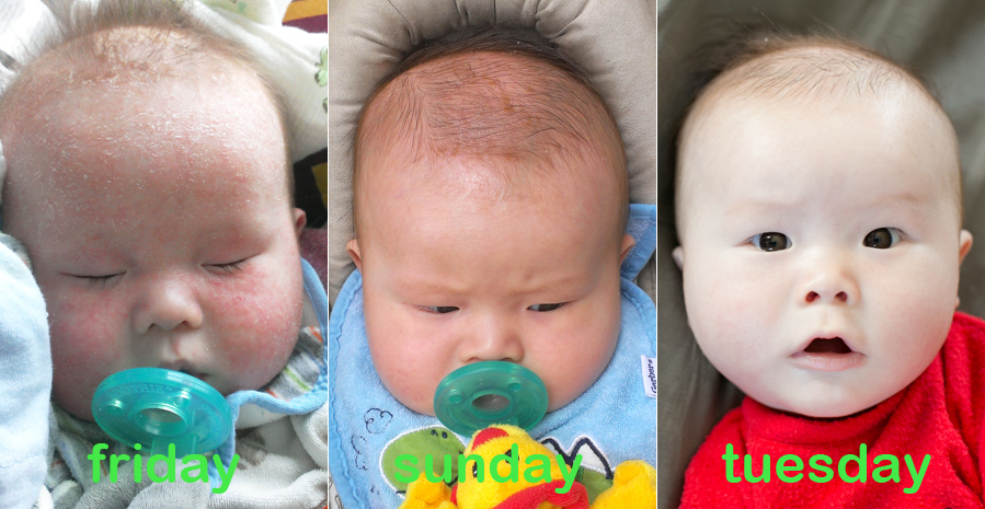 infant eczema protopic treatment