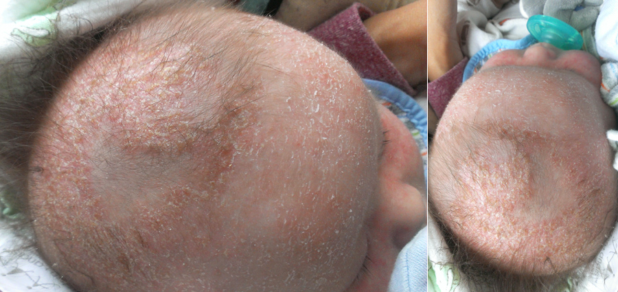 baby boy scalp eczema